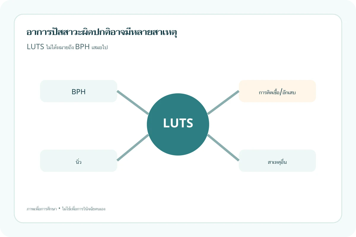 ภาพอินโฟกราฟิกแสดงว่า LUTS อาจเกี่ยวข้องกับหลายสาเหตุ ไม่ได้หมายถึง BPH เสมอไป