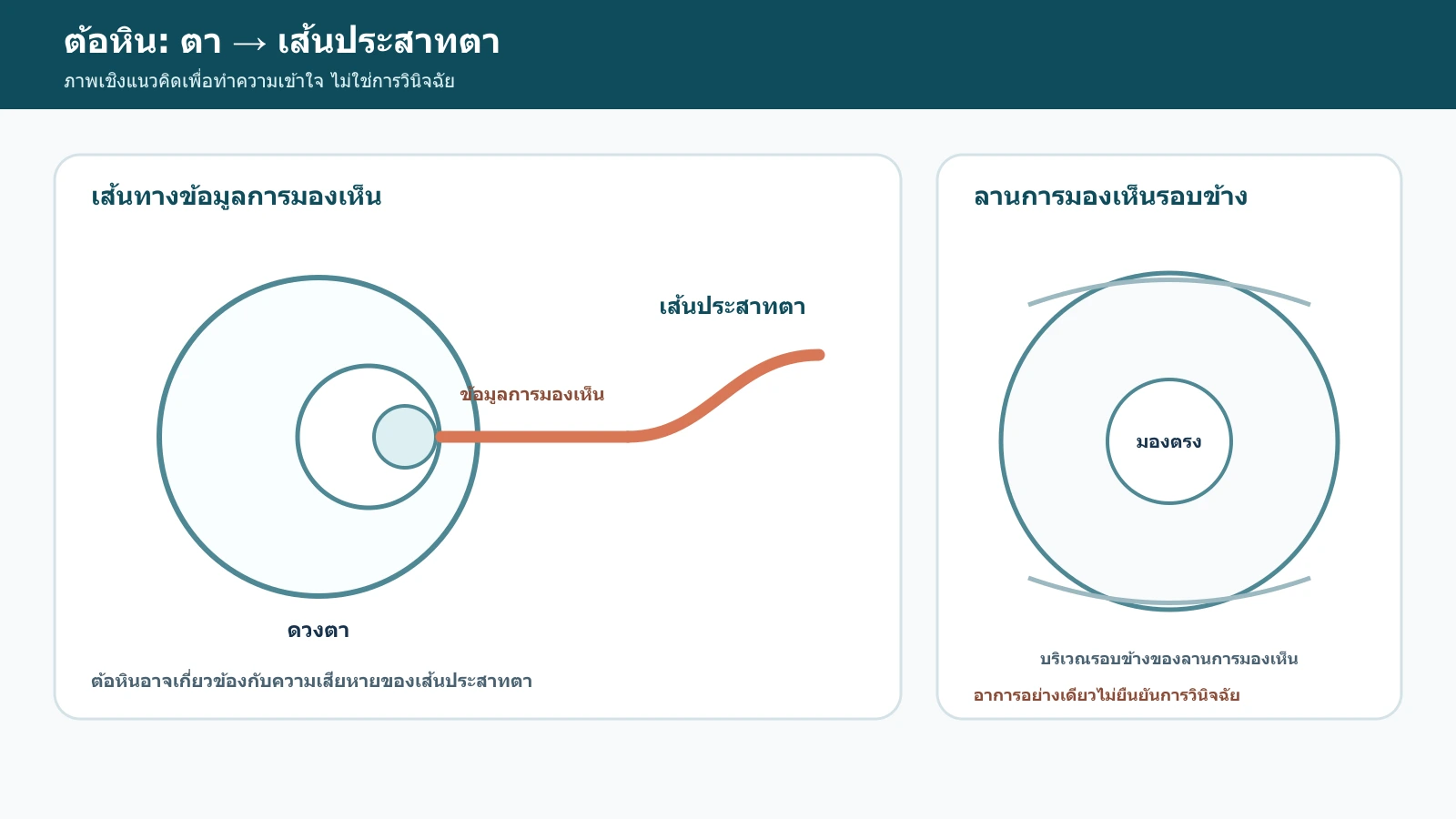 อินโฟกราฟิกอธิบายความสัมพันธ์ระหว่างต้อหิน เส้นประสาทตา และการมองเห็นรอบข้างในภาพรวม