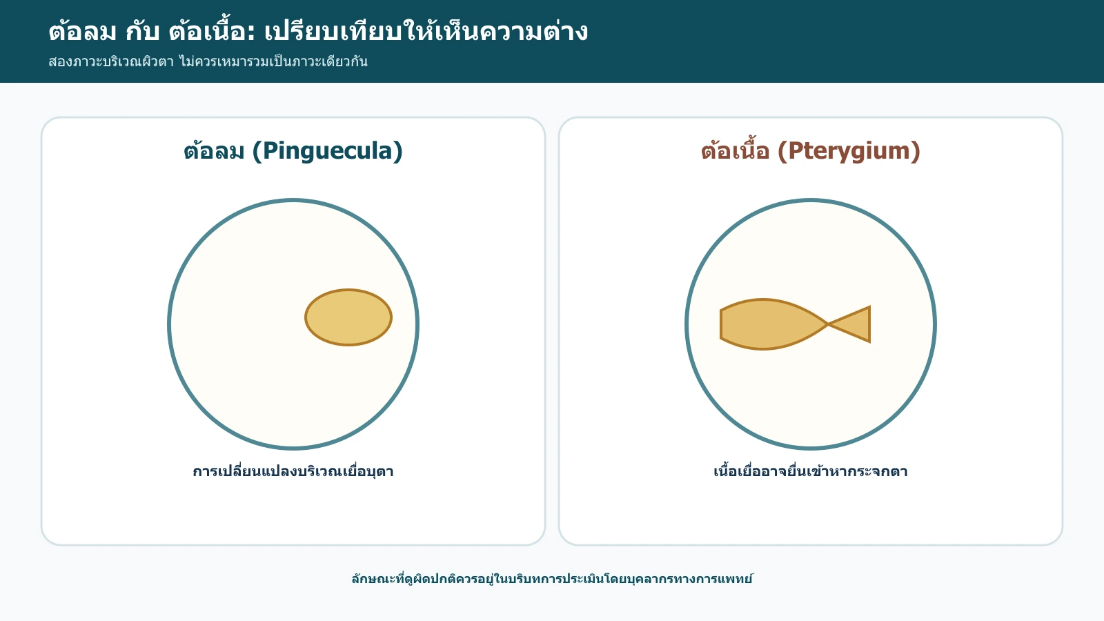 อินโฟกราฟิกเปรียบเทียบต้อลมและต้อเนื้อในภาพรวมโดยไม่ใช้ภาพเพื่อวินิจฉัยตนเอง